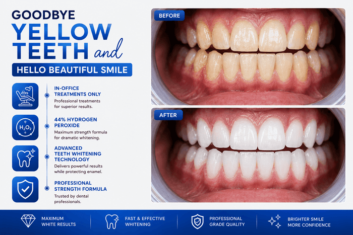 Professional teeth whitening before and after results using 44% hydrogen peroxide gel