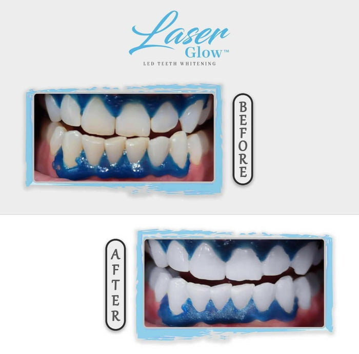 Gingival barrier helps protect gums during whitening