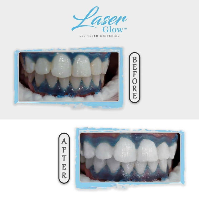 teeth whitening gum protection to avoid blanching during teeth whitening treatments.