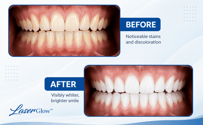 Before and after teeth whitening results using carbamide peroxide pen