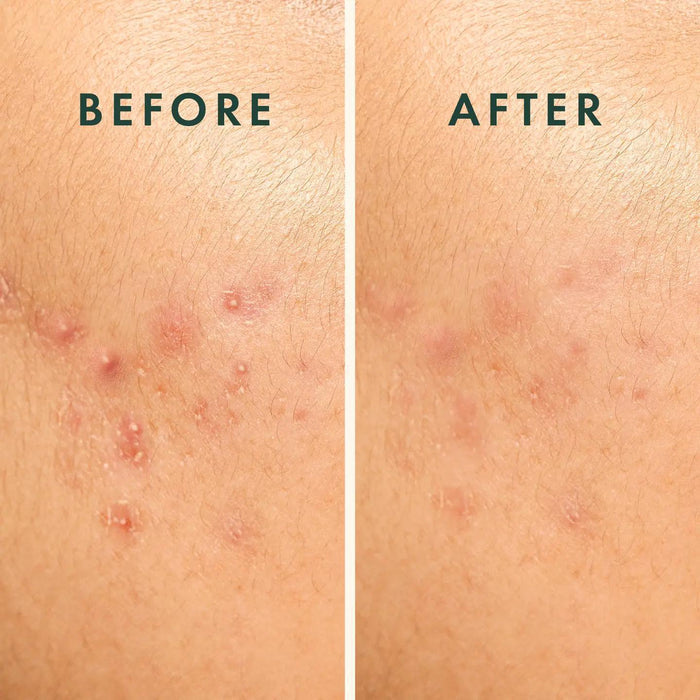 Rael Beauty Miracle Patch Spot Control Cover 4 patches